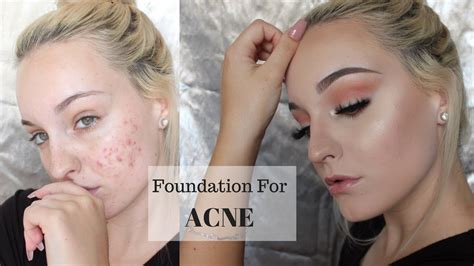 best foundation for acne scarring.